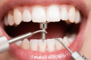 Pasang implan gigi Bekasi