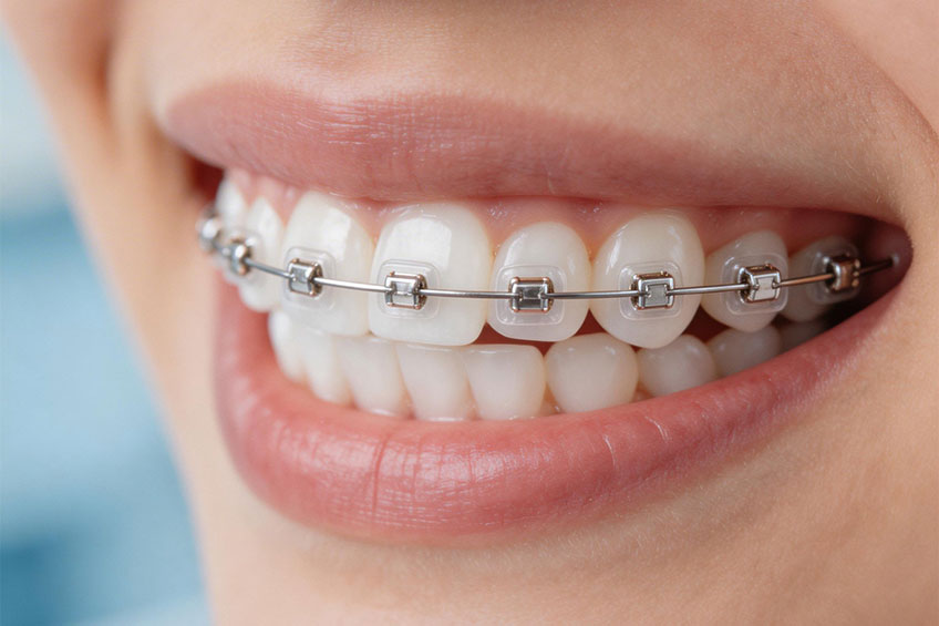 Perawatan Orthodonti (Behel) | Fungsi, Proses, dan Manfaat Jangka Panjang